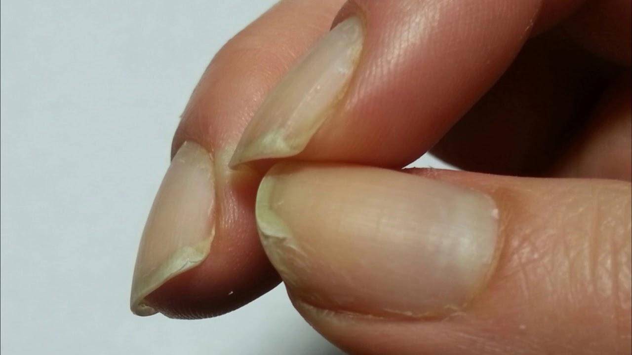 Что делать, если слоятся ногти на руках: способы лечения в домашних условиях. слоятся, крошатся, ломаются ногти: почему очень тонкие ногти, лечение, что делать в домашних условиях