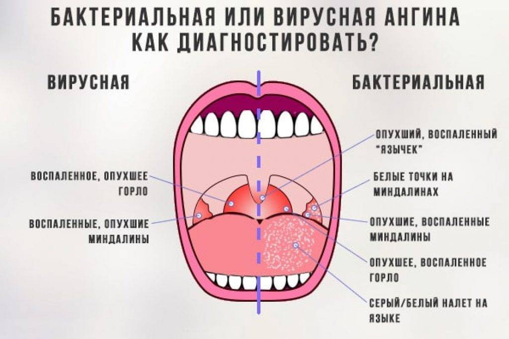 Болит горло коронавирус, орви или простуда. при коронавирусе болит горло или нет