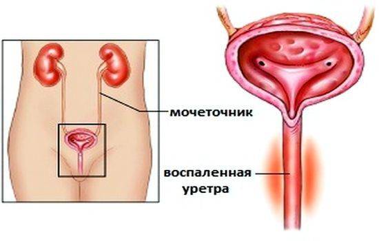 Кровь с болью при мочеиспускании у женщин