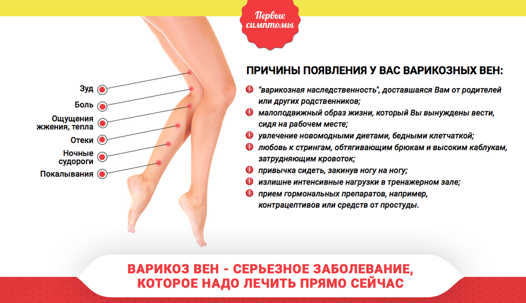 Болезненность ноги. Варикозное расширение причины. Факторы варикозного расширения вен. Варикозные заболевания нижних конечностей.