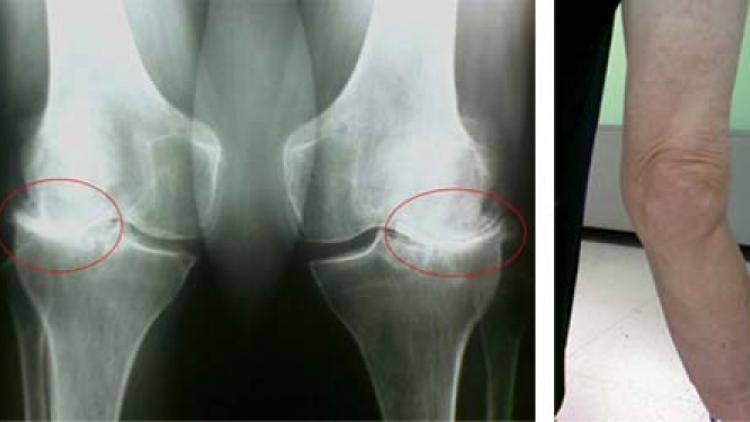 Изменение формы сустава. Гонартроз 3 степени рентген. Гонартроз 2 степени коленного сустава рентген. Гонартроз 3 степени коленного сустава рентген. Деформирующий артроз коленного сустава рентген.
