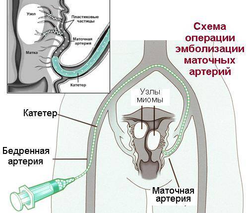 Эмболизация маточных артерий при миоме матки