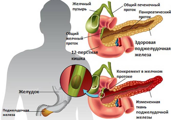 Первые симптомы плохой работы поджелудочной железы при панкреатите