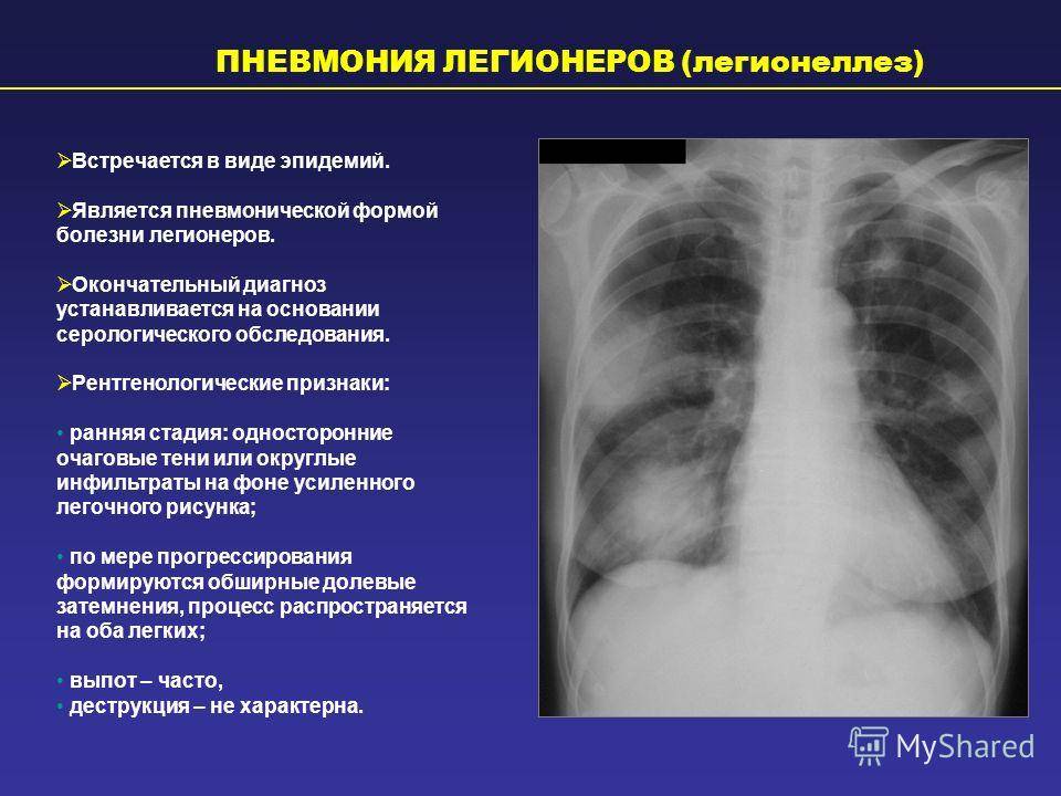 Фиброз после пневмонии: что это такое, как выглядят тяжи и рубцы на легких и обратимы ли изменения, а также симптомы, диагностика, лечение заболевания и прогноз | fok-zdorovie.ru
