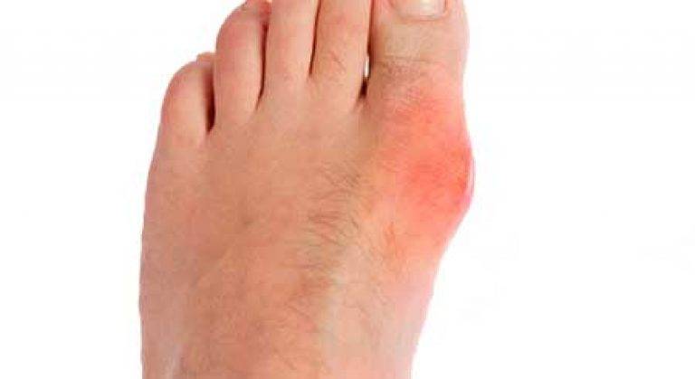 Болит косточка на ноге около большого пальца: лечение, причины