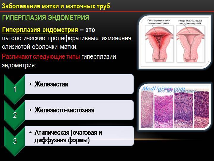 Гиперплазия эндометрия матки в менопаузу: что это такое, симптомы, причины, лечение