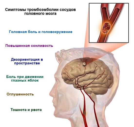 ✅ атеросклероз сосудов головного мозга симптомы и лечение у пожилых - денталюкс.su