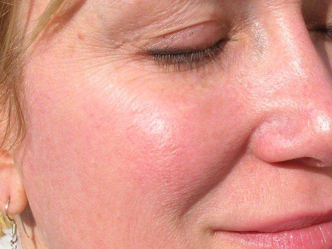 Как лечить розацеа на лице: фото симптомы и лечение у взрослых