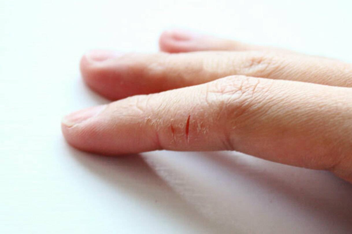 Почему трескаются и шелушатся подушечки пальцев рук: основные причины, лечение