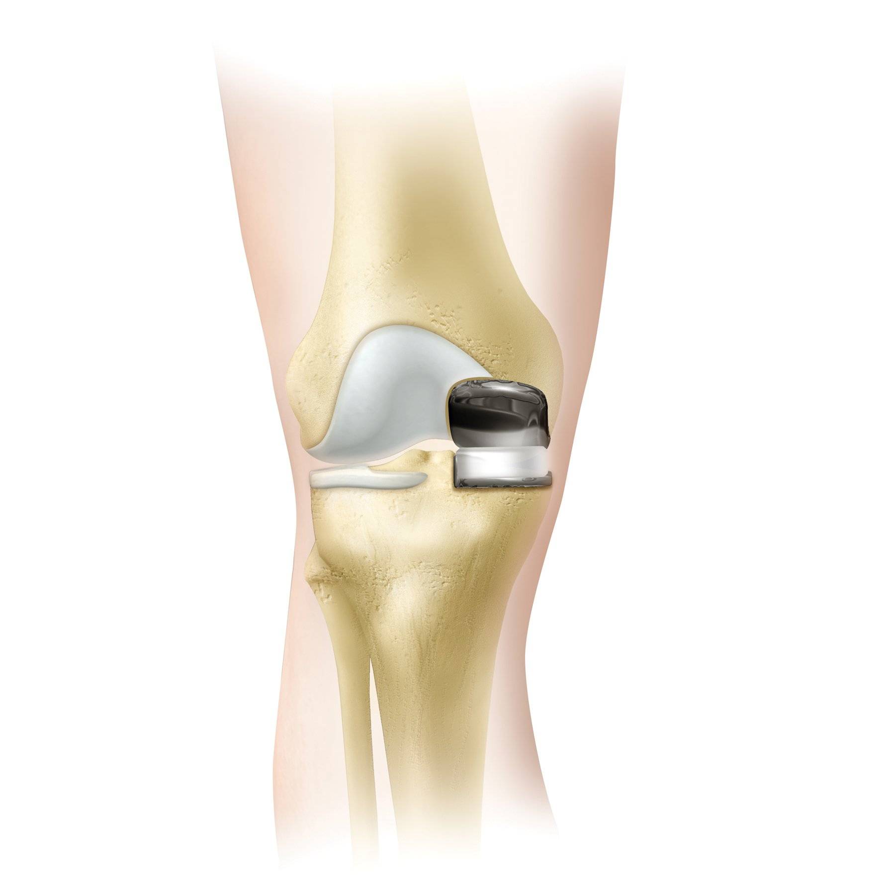 Операция по замене сустава на ноге. Коленный эндопротез Зиммер. Эндопротез коленного сустава. Эндопротез Зиммер коленного сустава. Артропластика коленного сустава.
