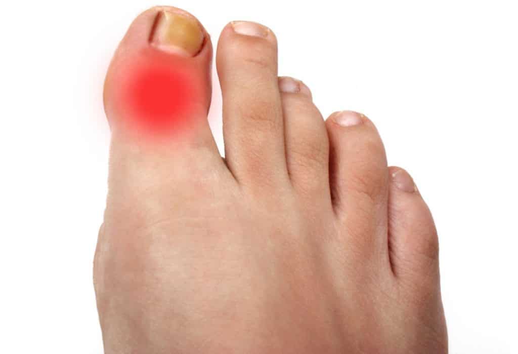 Болит большой палец на ноге в суставе, косточка, боли около ногтя: причины, что делать и как лечить