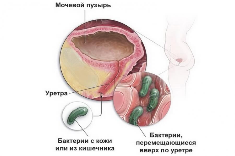 Лейкоплакия мочевого пузыря: причины возникновения, симптомы, диагностика и лечение