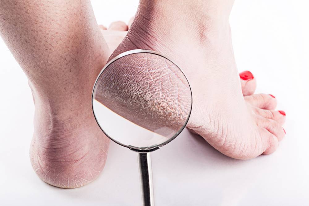 Сухая кожа на ногах: причины, как забыть о проблеме?