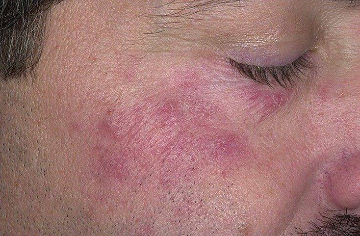 Покраснение щек: банальная аллергия или опасное заболевание? причины и лечение красноты