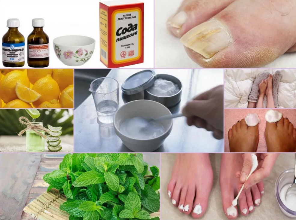 Как быстро вылечить грибок ногтей на ногах - рецептами народной медицины и лекарственными препаратами