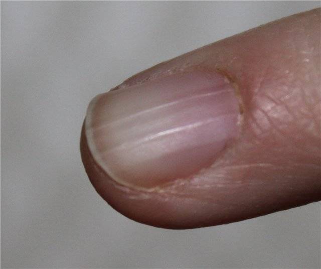 Белая полоска на ногте большого пальца ноги. почему появляются белые полоски на ногтях: лечение. причины появления белых отметин на ногтях