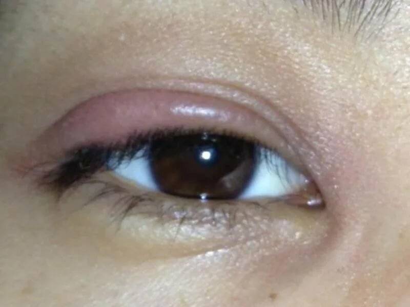 Красные веки глаз: причины у взрослого человека, лечение и профилактика