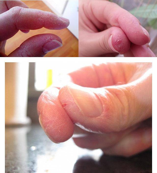 Шелушится кожа на пальцах рук: каковы симптомы и причины, а также почему иногда трескается и облезает только на кончиках, что делать и методы лечения