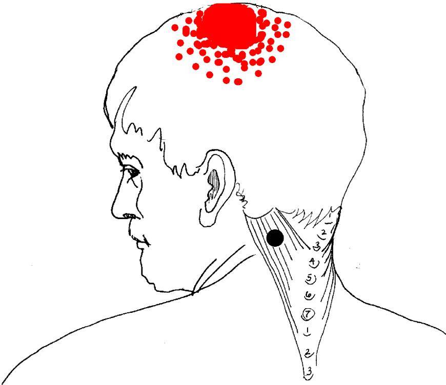 Болит голова слева сзади: основные причины и методы лечения