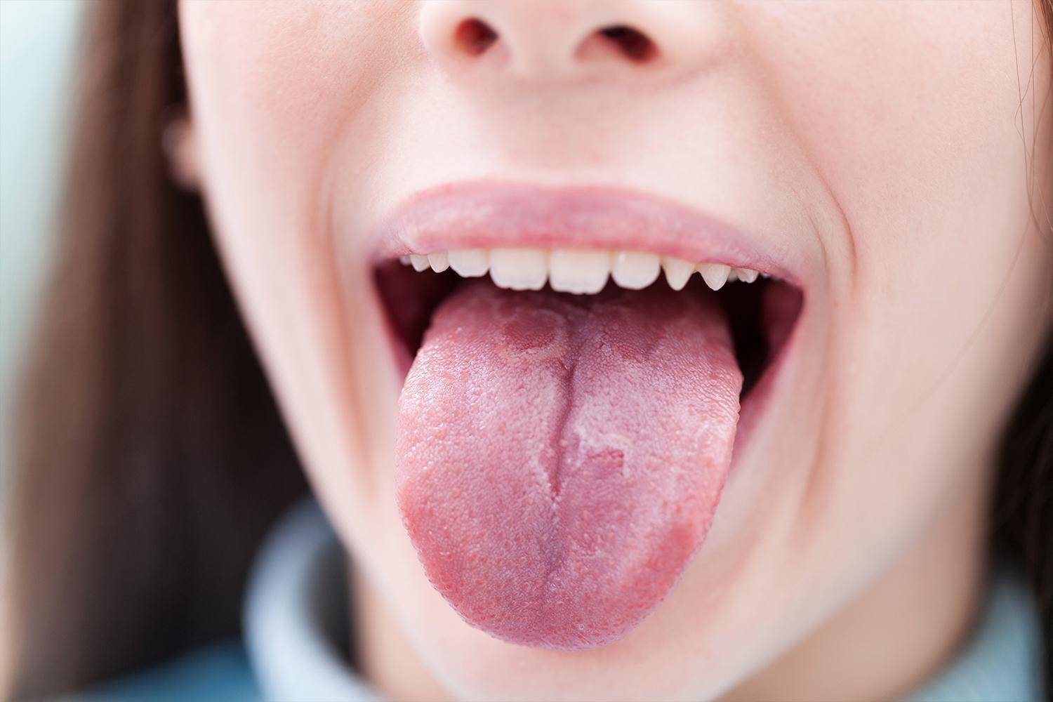 Кислый привкус во рту после еды: причины и лечение