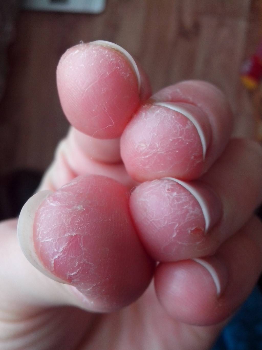 10 причин возникновения трещин на коже рук. лечение