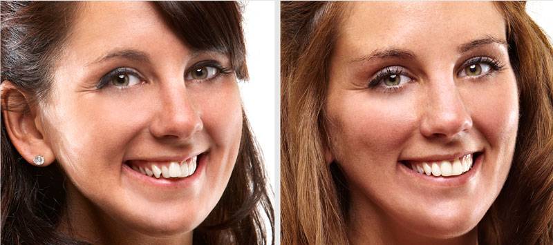 Побочный эффект лечения брекетами — увеличение объема губ