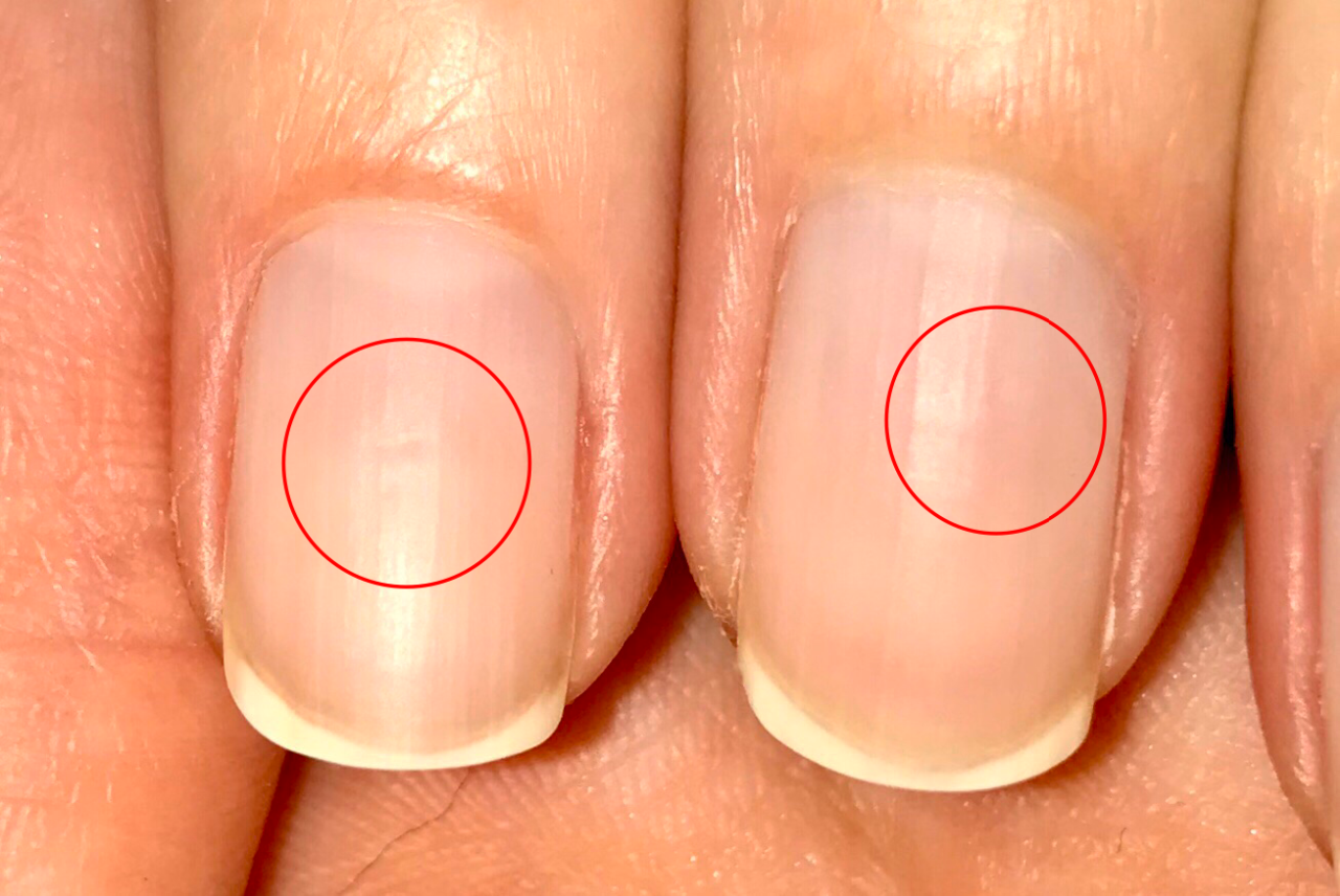 Полоски на ногтях - белые, черные, красные: причины появления, лечение, фото