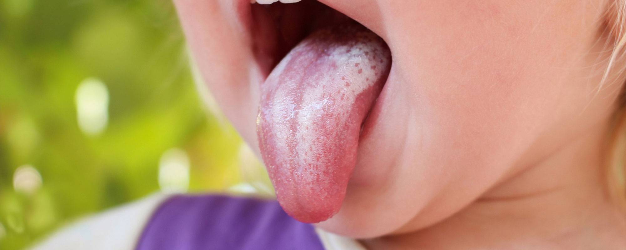 Кандидоз полости рта: фото языка, горла, симптомы во рту, ротовой полости у детей