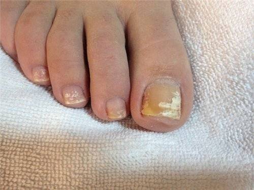 Почему желтеют ногти на ногах: причины, лечение, профилактика