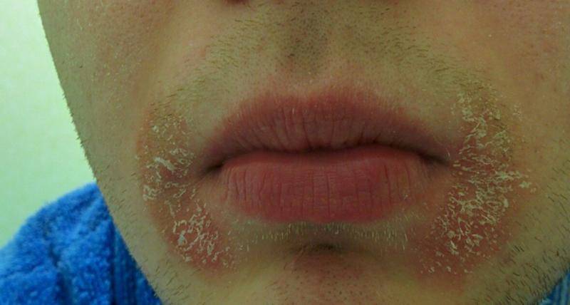 Покраснение и шелушение кожи на лице - фото, причины, лечение