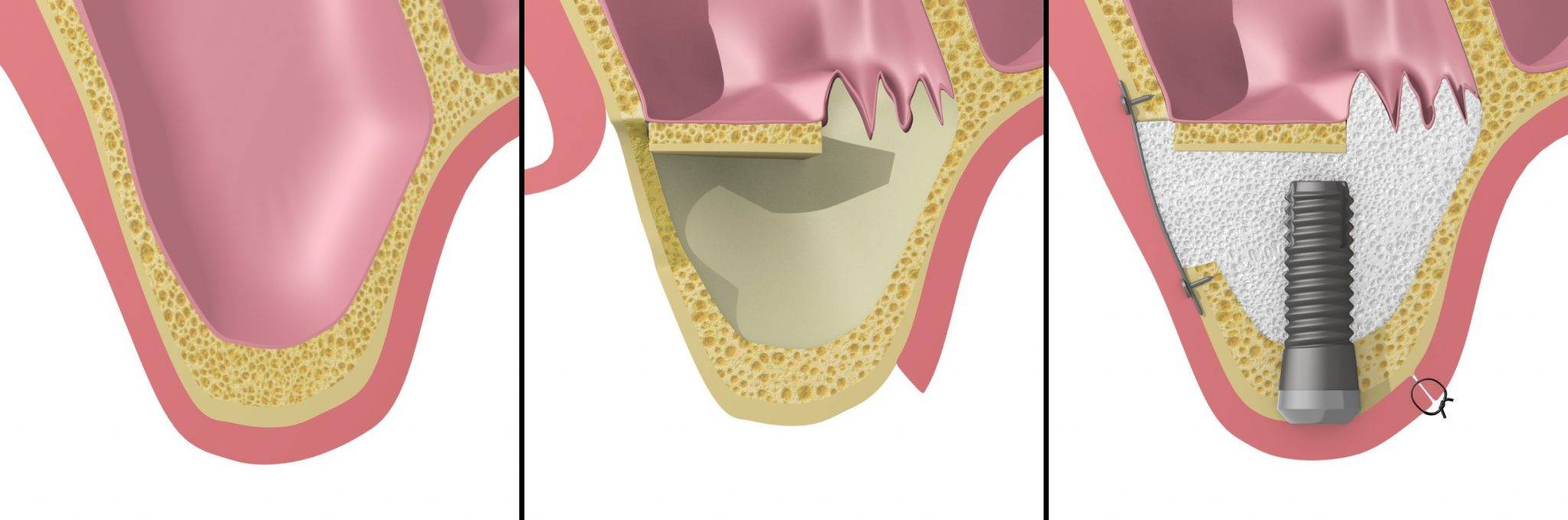 Отзывы о наращивании костной ткани при имплантации зубов