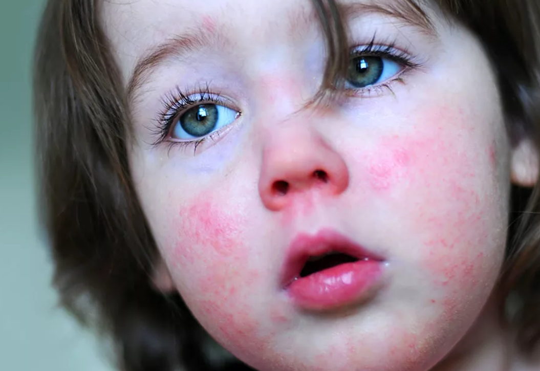 Cкарлатина у детей: симптомы, лечение, профилактика (10 фото) | детские болезни