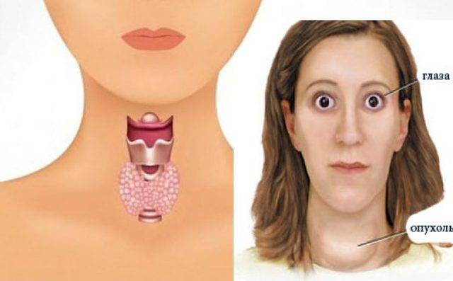 Первые симптомы проблем с щитовидной железой, которые не стоит игнорировать