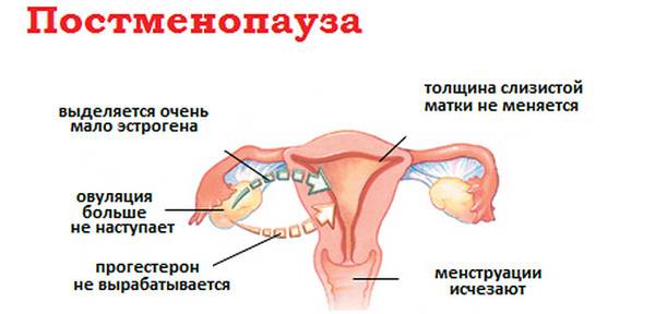 Серозометра у женщин в постменопаузе: что это такое, норма, причины скопления жидкости в матке, лечение