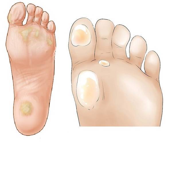Сухие мозоли на пальцах ног: лечение, как вывести в домашних условиях | компетентно о здоровье на ilive