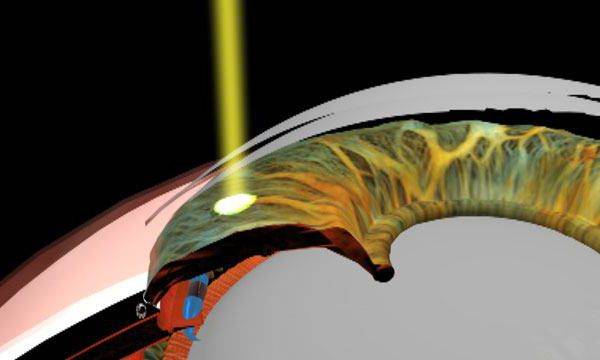 Лазерная иридэктомия при глаукоме – все об операции