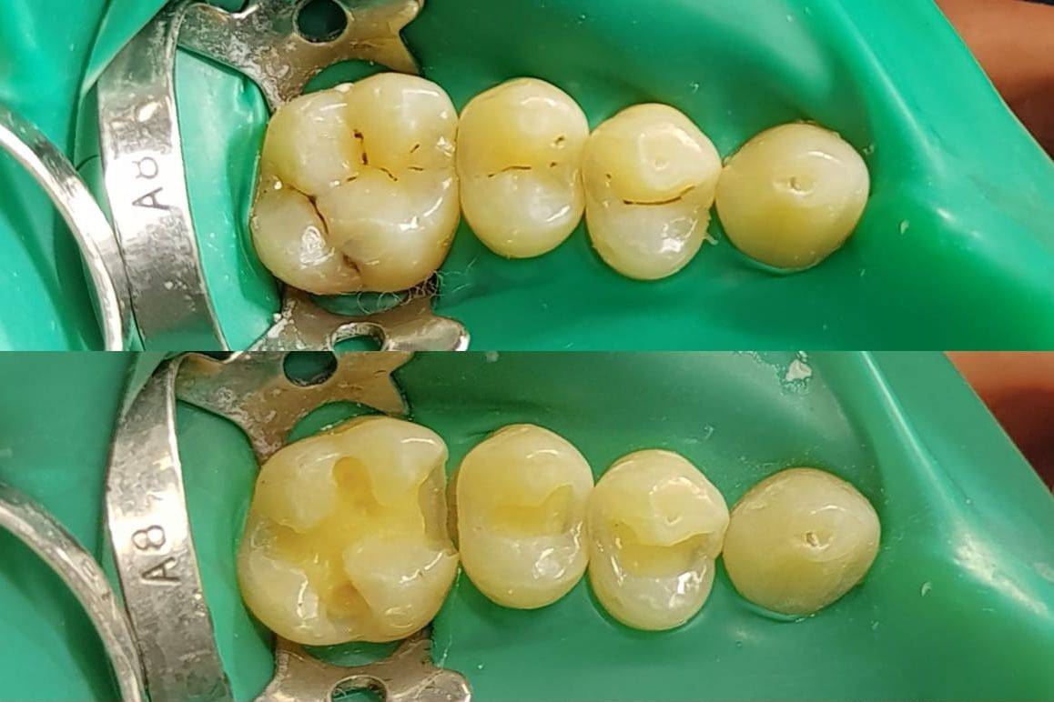 Методы лечения кариеса зубов: на передовой современной стоматологии