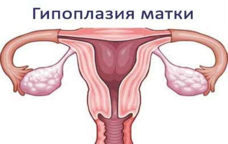 Гипоплазия или маленькая матка: причины, стадии, проявления и методы лечения. риски, связанные с беременностью, гипоплазия эндометрия и поликистоз