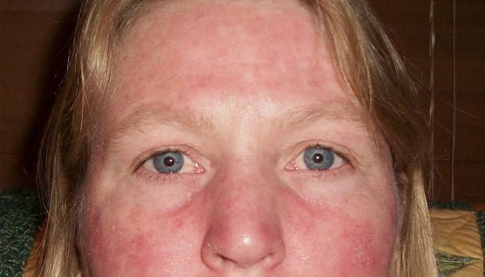 Покраснение щек у взрослых причины — аллергия