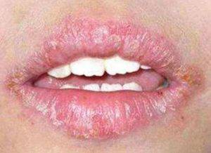 Трескаются уголки губ. причины, лечение, сохнут по бокам, в середине, шелушатся, каких витаминов не хватает