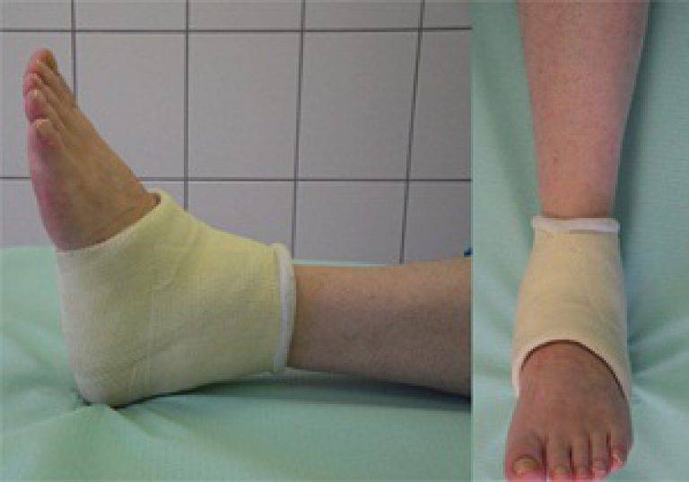 Перелом пальца на ноге: лечение, симптомы и первая помощь