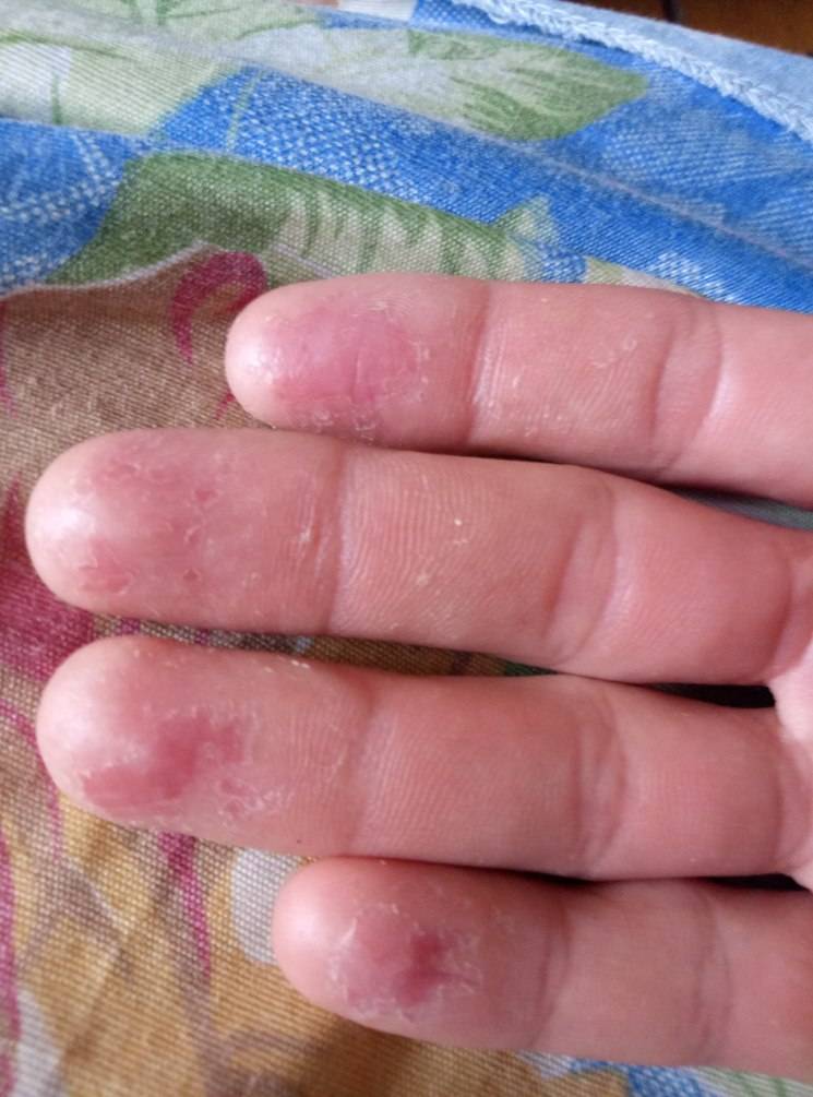 Облазит кожа на пальцах рук: фото, причины, лечение