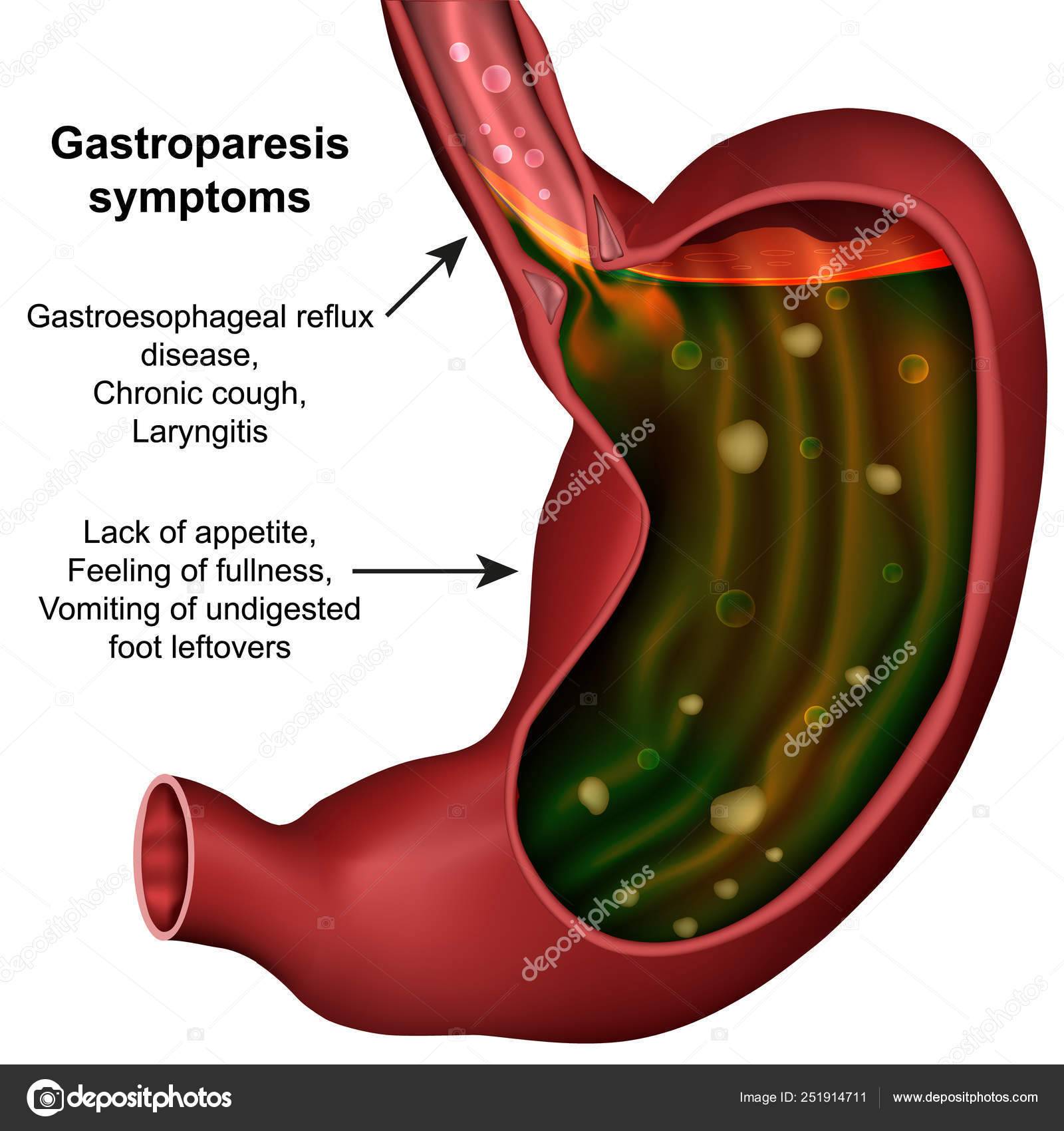 Гастропарез желудка: причины, симптомы, лечение, диагностика, профилактика