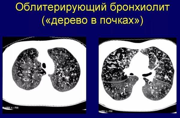 Особенности течения и терапии острого бронхиолита у детей и взрослых