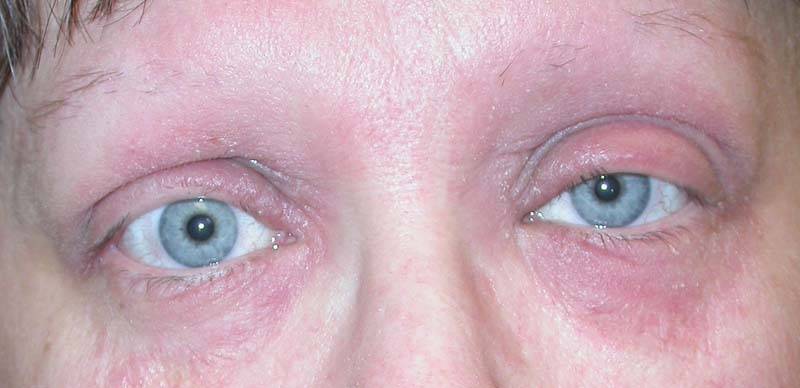 Покраснение глаз, причины и лечение, эффективные препараты