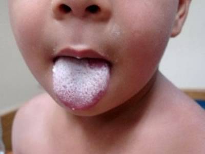 Cыпь при скарлатине – как выглядит, как проявляется скарлатина у детей (фото)?