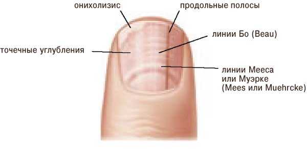 Продольные полосы на ногтях рук причины в заболеваниях