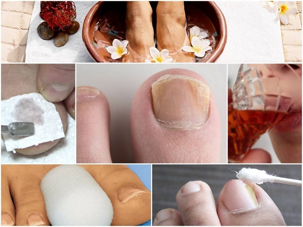 Лечение грибка ногтей народными средствами. рецепты, эффект