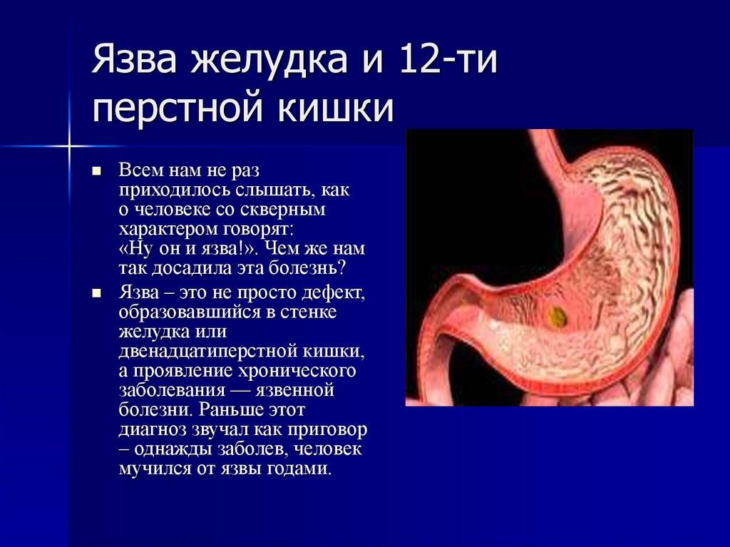 Как вызвать язву. Язвенная болезнь 12 перстной кишки макропрепарат. Язва 12 перстной кишки макропрепарат. Язвенная болезнь болезнь желудка и 12 перстной кишки. Язва желудка и 12 перстной кишки.