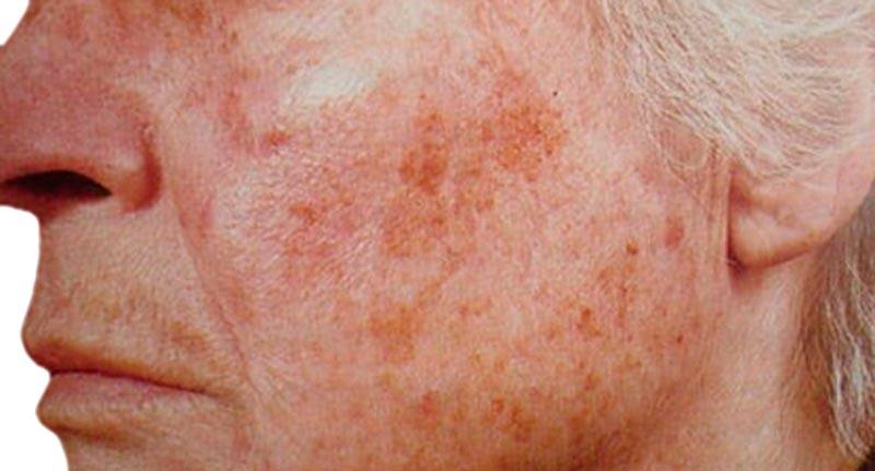Пигментация кожи на лице: причины и лечение
